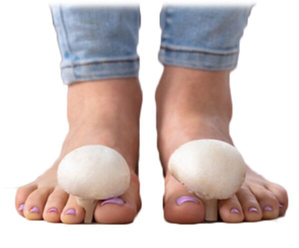 Micosis en la superficie del pie y las uñas. 