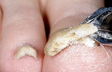 etapa avanzada de la infección por hongos en las uñas