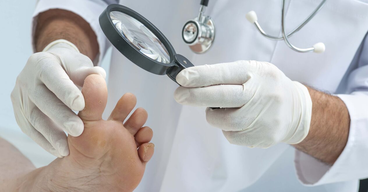 El médico examina los pies en busca de hongos en las uñas.