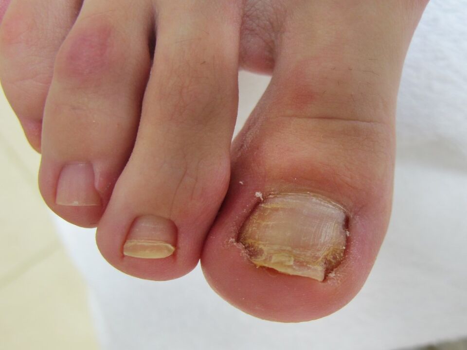 síntomas de hongos en las uñas de los pies