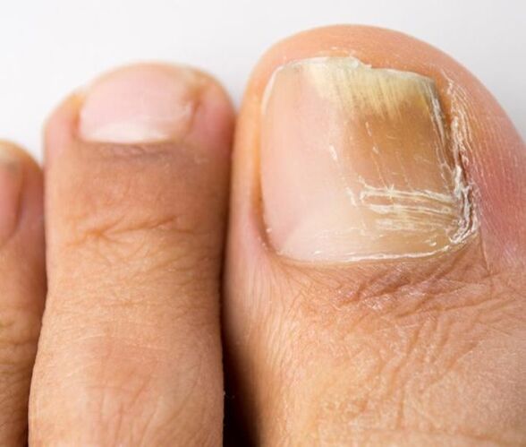 infección por hongos en las uñas de los pies