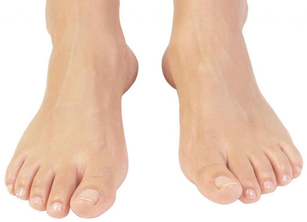 uñas de los pies saludables después del tratamiento de hongos