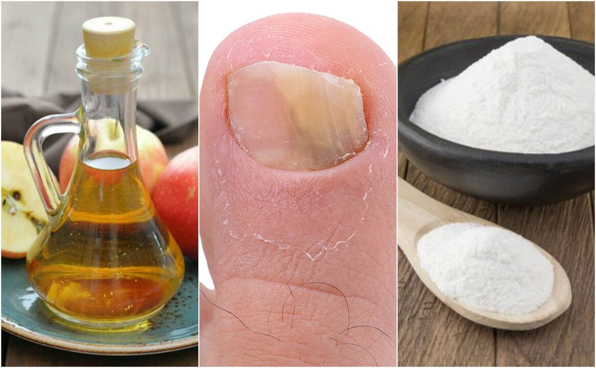 como curar los hongos en las uñas de los pies