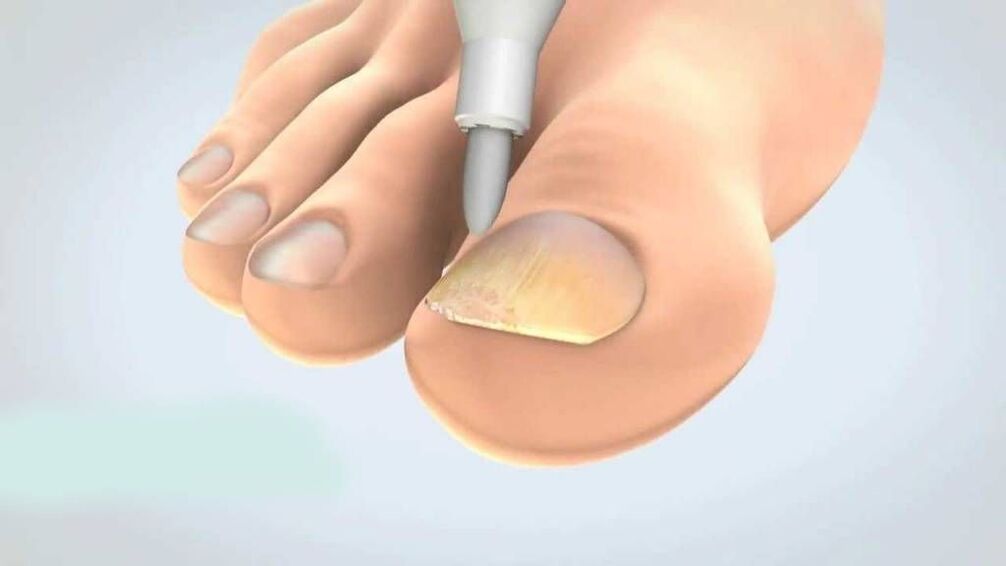 tratamiento de hongos en las uñas de los pies