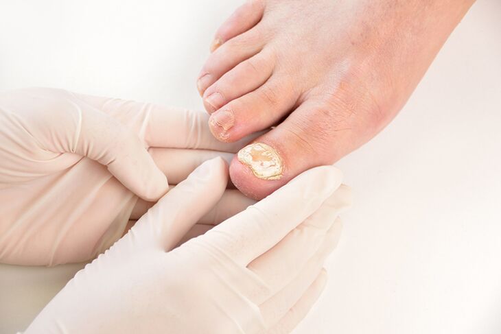 Antes de prescribir el tratamiento, el médico debe diagnosticar el hongo de las uñas de los pies. 