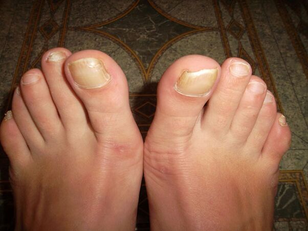 Engrosamiento de las uñas de los pies con onicomicosis