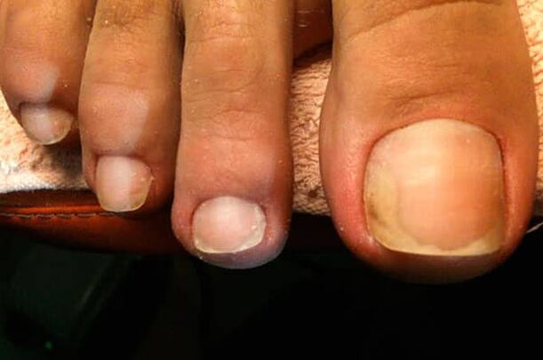 Los hongos en las uñas comienzan en el dedo gordo del pie