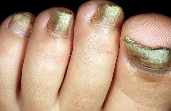 etapa avanzada de hongos en las uñas de los pies