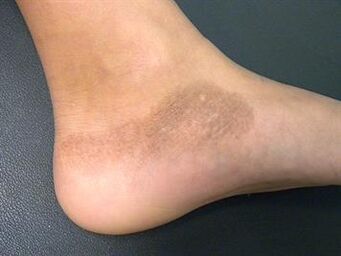 La micosis de los pies se acompaña de un cambio en el tono de la piel. 