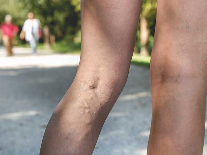 Las venas varicosas son un factor de riesgo para la infección por hongos en los pies