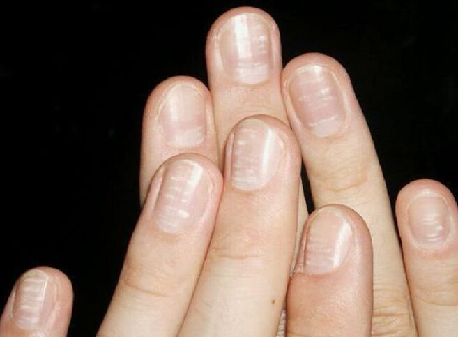 Las manchas blancas en las uñas son un signo de desarrollo de hongos