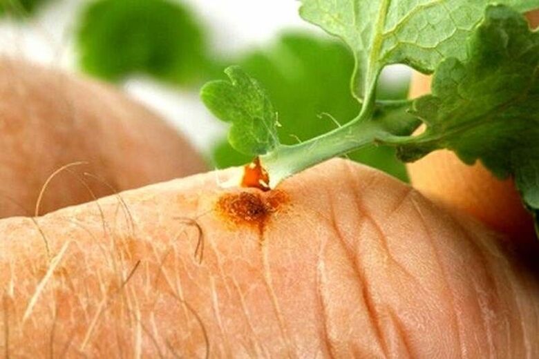 celidonia contra hongos en las uñas