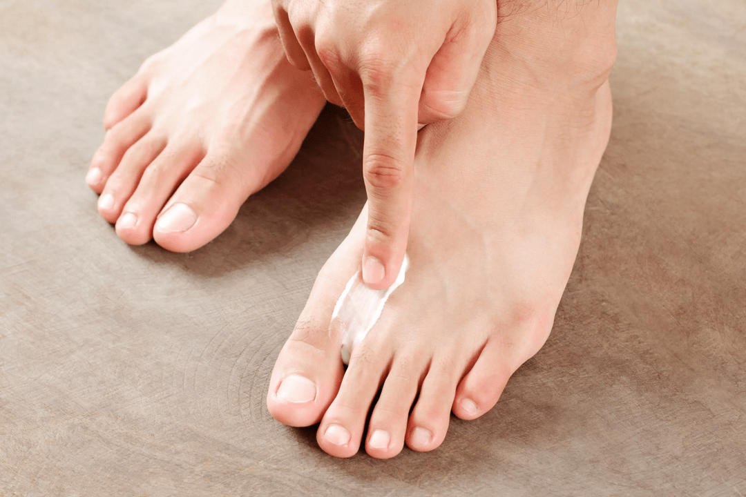 aplicar un ungüento antimicótico en la piel del pie