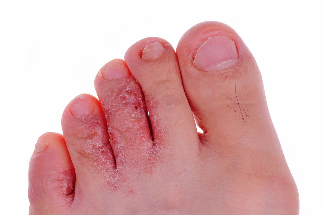 infección por hongos de la piel entre los dedos de los pies