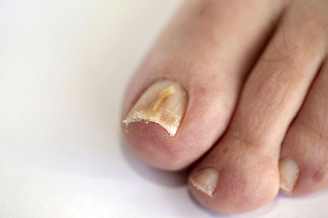 síntomas de hongos en las uñas de los pies