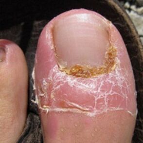 Hongo de uñas