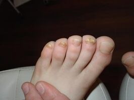 El hongo de las uñas ocurre incluso en niños