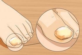 Hongo de uñas