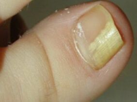 Hongo de uñas