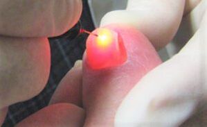Tratamiento del hongo de las uñas con un láser