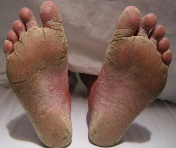 Derrota micótica de los pies