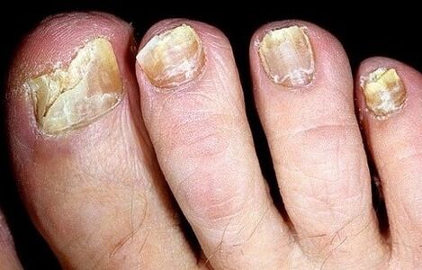 Las uñas se desmoronan del hongo