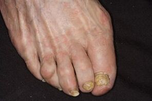 Tratamiento del hongo de las uñas en las piernas Vinagre de sidra de manzana