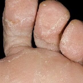 etapas de los hongos en las uñas