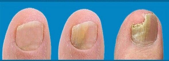 proceso de desarrollo de hongos