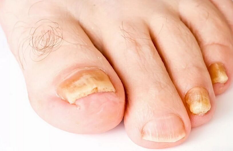 hongos en las uñas de los pies