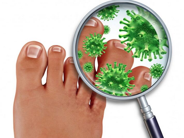 micosis