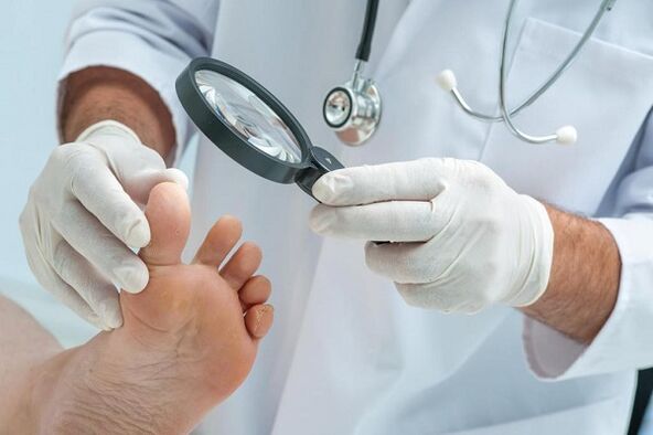 Causas y tratamiento de hongos en las uñas de los pies.