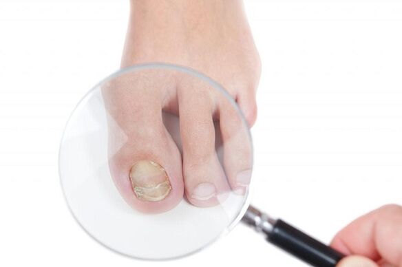 etapas y etapas de desarrollo de hongos en las uñas de los pies