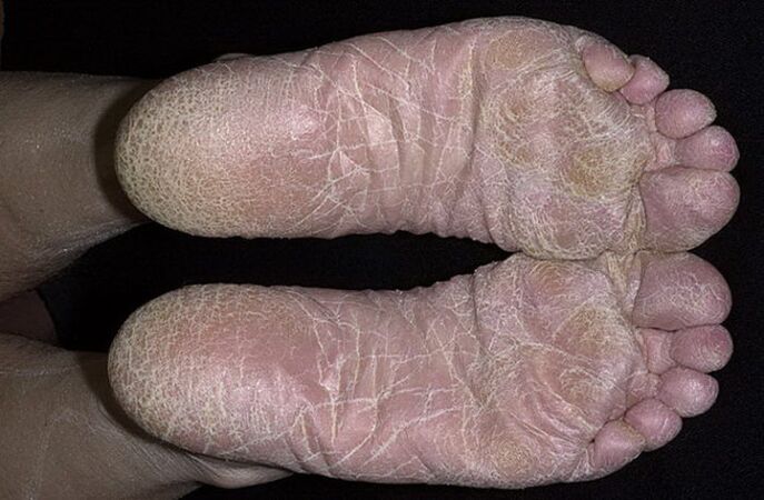 hongos en los pies