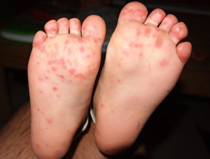 hongos vesiculares en las piernas