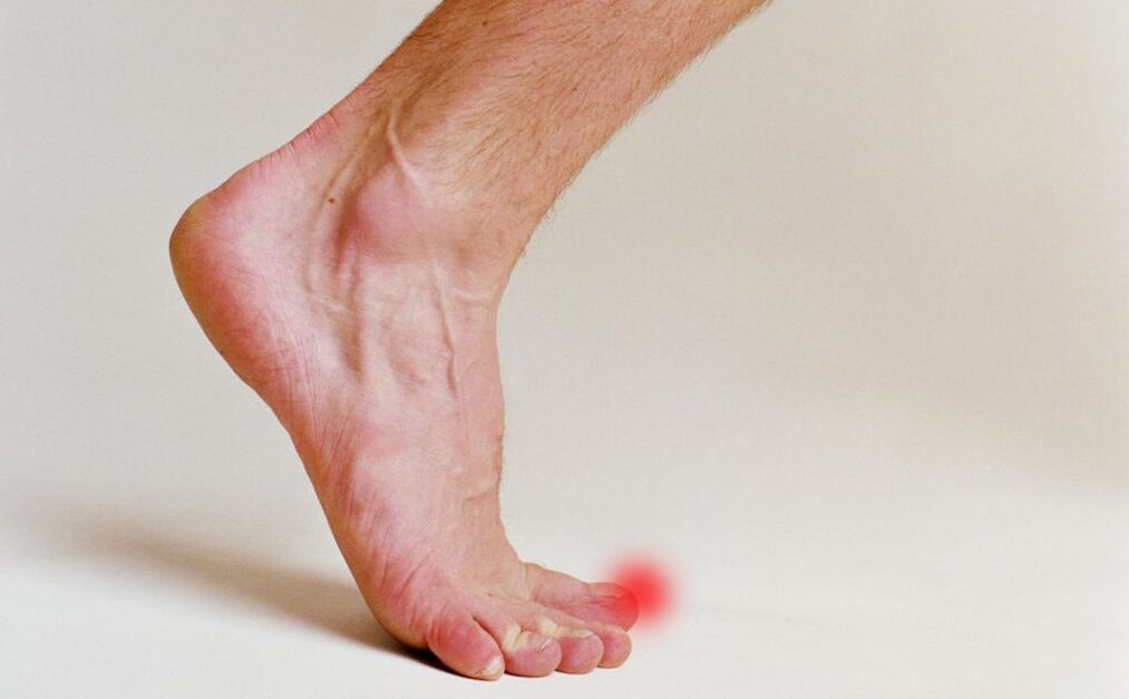 Hongos en las uñas del dedo gordo del pie