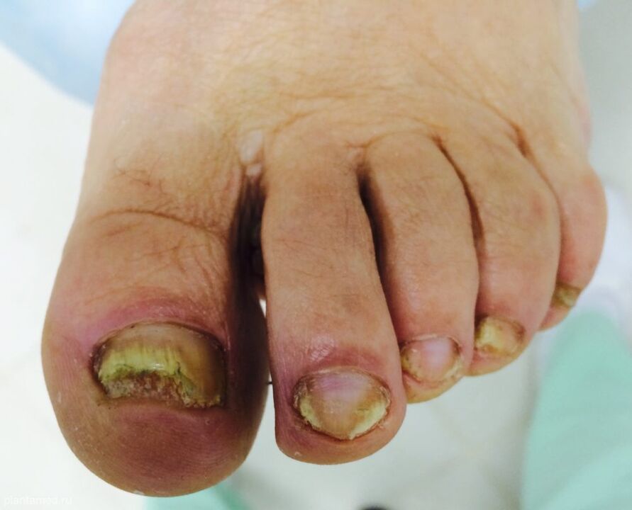 La deformación severa de las uñas de los pies es un signo de la tercera etapa avanzada del hongo.